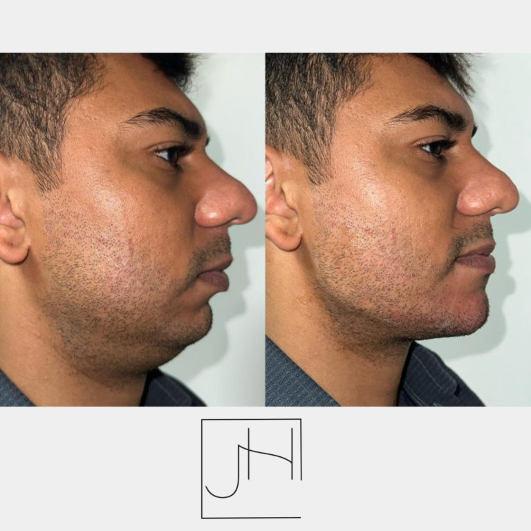 Harmonização fácial homem