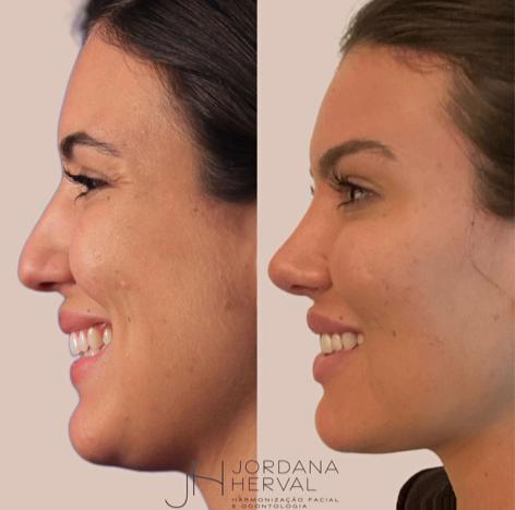 Como funciona a Rinomodelação