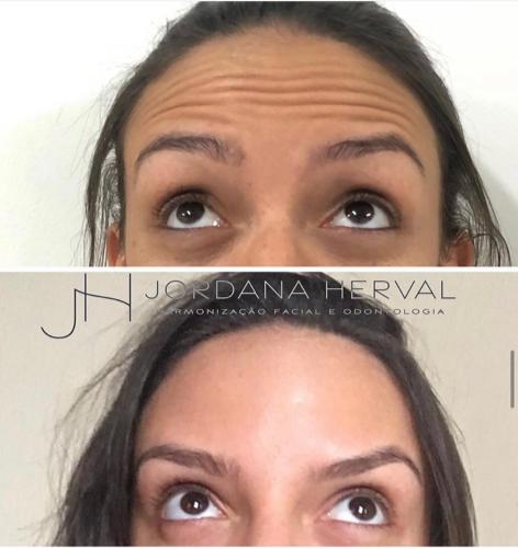 Botox em mulher
