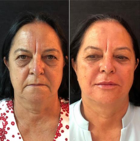 Harmonização Facial mulher