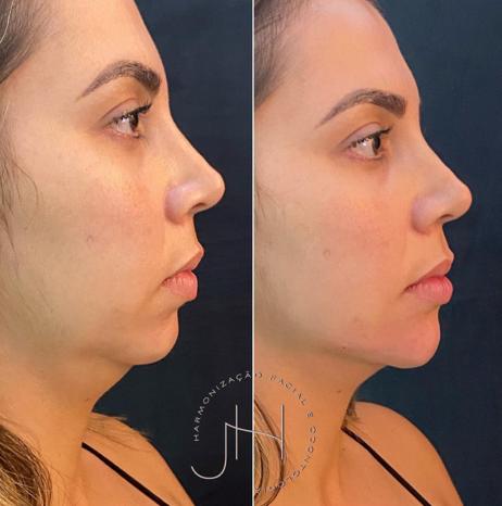 Antes e depois nariz