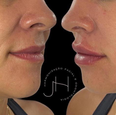 Preenchimento labial